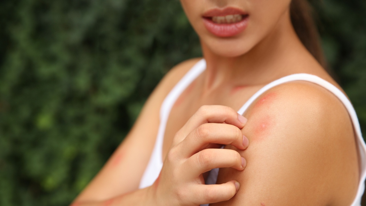 Woman scratching shoulder with insect bite outdoors, parasite